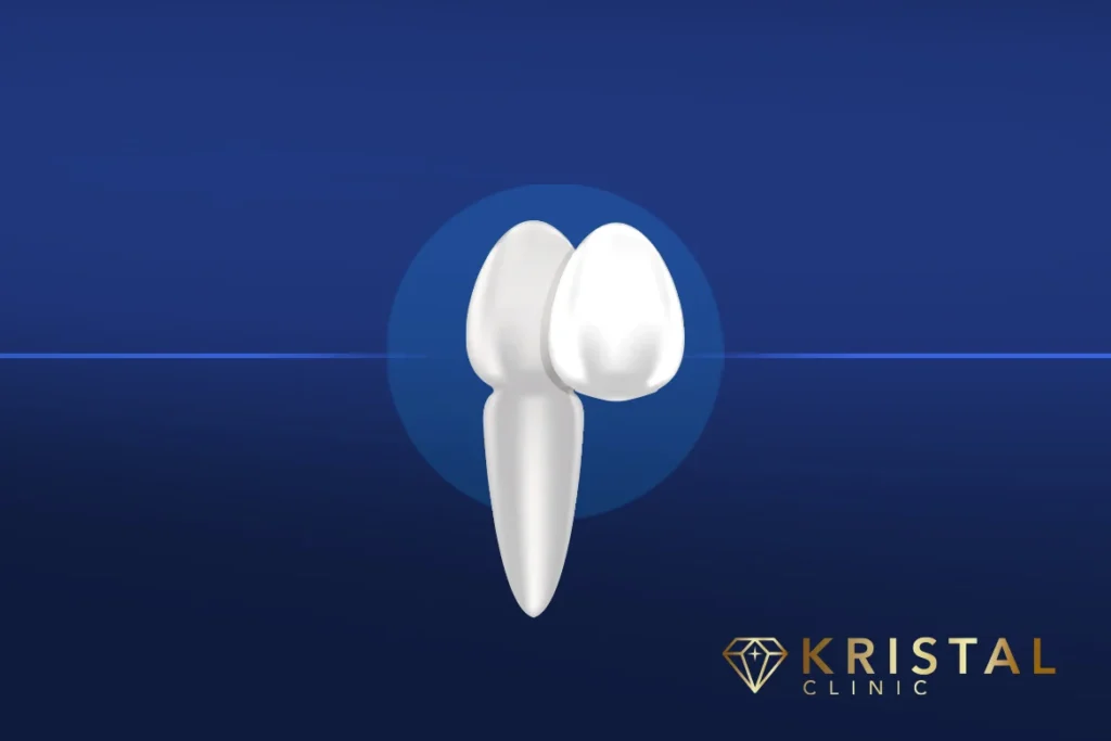 dental crowns